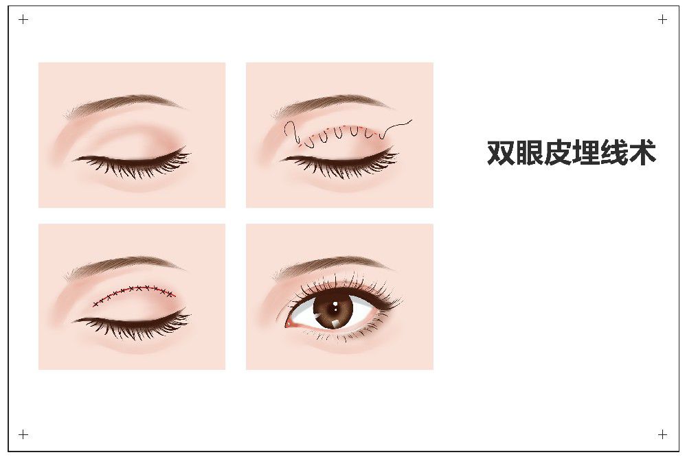 双眼皮重睑术